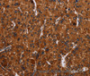 Immunohistochemistry of paraffin-embedded Human liver cancer tissue using RTN4R Polyclonal Antibody at dilution 1:50