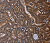 Immunohistochemistry of paraffin-embedded Human thyroid cancer tissue using RTN4R Polyclonal Antibody at dilution 1:50