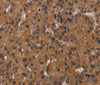 Immunohistochemistry of paraffin-embedded Human liver cancer tissue using NPRL2 Polyclonal Antibody at dilution 1:50