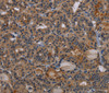 Immunohistochemistry of paraffin-embedded Human thyroid cancer tissue using NPRL2 Polyclonal Antibody at dilution 1:50