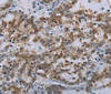 Immunohistochemistry of paraffin-embedded Human liver cancer tissue using MED12 Polyclonal Antibody at dilution 1:40