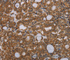 Immunohistochemistry of paraffin-embedded Human thyroid cancer tissue using PARP8 Polyclonal Antibody at dilution 1:40