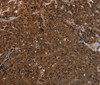 Immunohistochemistry of paraffin-embedded Human ovarian cancer tissue using KDM4B Polyclonal Antibody at dilution 1:50