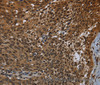 Immunohistochemistry of paraffin-embedded Human cervical cancer tissue using KDM4B Polyclonal Antibody at dilution 1:50