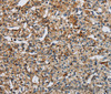 Immunohistochemistry of paraffin-embedded Human prostate cancer tissue using PERK Polyclonal Antibody at dilution 1:50