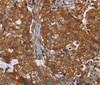 Immunohistochemistry of paraffin-embedded Human breast cancer tissue using PLEC Polyclonal Antibody at dilution 1:40