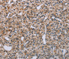 Immunohistochemistry of paraffin-embedded Human prostate cancer tissue using PNPT1 Polyclonal Antibody at dilution 1:40