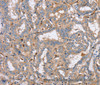 Immunohistochemistry of paraffin-embedded Human thyroid cancer using PPM1F Polyclonal Antibody at dilution of 1:40