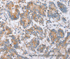 Immunohistochemistry of paraffin-embedded Human colon cancer using PPM1F Polyclonal Antibody at dilution of 1:40