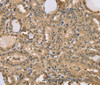 Immunohistochemistry of paraffin-embedded Human thyroid cancer using CENPV Polyclonal Antibody at dilution of 1:40