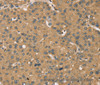 Immunohistochemistry of paraffin-embedded Human liver cancer using KDM5A Polyclonal Antibody at dilution of 1:45