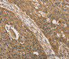 Immunohistochemistry of paraffin-embedded Human esophagus cancer using KDM5A Polyclonal Antibody at dilution of 1:45