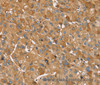 Immunohistochemistry of paraffin-embedded Human liver cancer using TRIM34 Polyclonal Antibody at dilution of 1:30