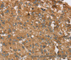 Immunohistochemistry of paraffin-embedded Human liver cancer tissue using RPS6KA2 Polyclonal Antibody at dilution 1:40