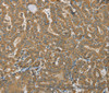 Immunohistochemistry of paraffin-embedded Human thyroid cancer using SDHB Polyclonal Antibody at dilution of 1:30