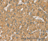 Immunohistochemistry of paraffin-embedded Human liver cancer using SEC14L2 Polyclonal Antibody at dilution of 1:40