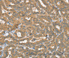 Immunohistochemistry of paraffin-embedded Human thyroid cancer using SEC14L2 Polyclonal Antibody at dilution of 1:40