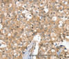 Immunohistochemistry of paraffin-embedded Human breast cancer tissue using SLC6A7 Polyclonal Antibody at dilution 1:30
