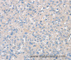 Immunohistochemistry of paraffin-embedded Human liver cancer using SNX3 Polyclonal Antibody at dilution of 1:30
