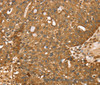 Immunohistochemistry of paraffin-embedded Human breast cancer using STARD5 Polyclonal Antibody at dilution of 1:40