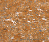 Immunohistochemistry of paraffin-embedded Human liver cancer tissue using ABCC9 Polyclonal Antibody at dilution 1:50