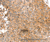 Immunohistochemistry of paraffin-embedded Human esophagus cancer tissue using ABCC9 Polyclonal Antibody at dilution 1:50