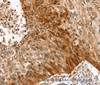 Immunohistochemistry of paraffin-embedded Human esophagus cancer tissue using SYNPO2 Polyclonal Antibody at dilution 1:50