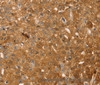 Immunohistochemistry of paraffin-embedded Human breast cancer tissue using TMSB10 Polyclonal Antibody at dilution 1:35