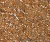 Immunohistochemistry of paraffin-embedded Human liver cancer tissue using TBC1D1 Polyclonal Antibody at dilution 1:45