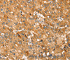 Immunohistochemistry of paraffin-embedded Human liver cancer using TRIM62 Polyclonal Antibody at dilution of 1:30
