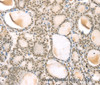 Immunohistochemistry of paraffin-embedded Human thyroid cancer using TSPAN13 Polyclonal Antibody at dilution of 1:35