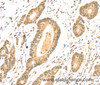 Immunohistochemistry of paraffin-embedded Human colon cancer using TSPAN13 Polyclonal Antibody at dilution of 1:35
