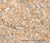 Immunohistochemistry of paraffin-embedded Human liver cancer using EVA1A Polyclonal Antibody at dilution of 1:30