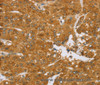 Immunohistochemistry of paraffin-embedded Human liver cancer tissue using TNFSF13 Polyclonal Antibody at dilution 1:40