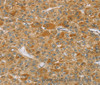 Immunohistochemistry of paraffin-embedded Human liver cancer using TP53I11 Polyclonal Antibody at dilution of 1:40