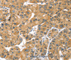 Immunohistochemistry of paraffin-embedded Human liver cancer using PRSS50 Polyclonal Antibody at dilution of 1:30