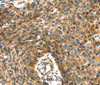 Immunohistochemistry of paraffin-embedded Human esophagus cancer using PRSS50 Polyclonal Antibody at dilution of 1:30