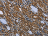 Immunohistochemistry of paraffin-embedded Human thyroid cancer using SMAD4 Polyclonal Antibody at dilution of  1/40