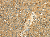 Immunohistochemistry of paraffin-embedded Human breast cancer tissue using Cathepsin H Polyclonal Antibody at dilution 1:50