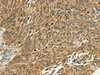 Immunohistochemistry of paraffin-embedded Human lung cancer tissue using PSMD10 Polyclonal Antibody at dilution 1:40