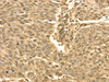 Immunohistochemistry of paraffin-embedded Human lung cancer using SEPT2 Polyclonal Antibody at dilution of  1/30