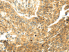 Immunohistochemistry of paraffin-embedded Human lung cancer tissue using SERPINA12 Polyclonal Antibody at dilution 1:40