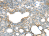 Immunohistochemistry of paraffin-embedded Human thyroid cancer using SERPINB11 Polyclonal Antibody at dilution of  1/20