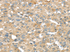 Immunohistochemistry of paraffin-embedded Human liver cancer tissue using SRP54 Polyclonal Antibody at dilution 1:45