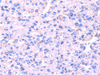 Immunohistochemistry of paraffin-embedded Human liver cancer using SRPK1 Polyclonal Antibody at dilution of  1/45
