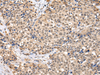 Immunohistochemistry of paraffin-embedded Human breast cancer using TBL1X Polyclonal Antibody at dilution of  1/30