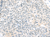 Immunohistochemistry of paraffin-embedded Human lung cancer tissue using ELOC Polyclonal Antibody at dilution 1:40