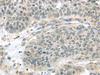 Immunohistochemistry of paraffin-embedded Human lung cancer using THAP4 Polyclonal Antibody at dilution of  1/30