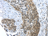 Immunohistochemistry of paraffin-embedded Human esophagus cancer tissue using TKTL1 Polyclonal Antibody at dilution 1:40