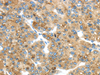 Immunohistochemistry of paraffin-embedded Human liver cancer using TMED4 Polyclonal Antibody at dilution of  1/45